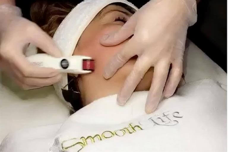 Derma Roller